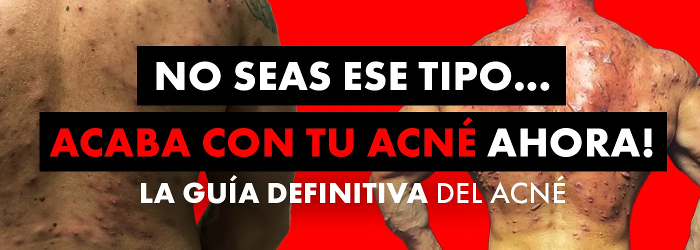 ACNÉ Y ESTEROIDES