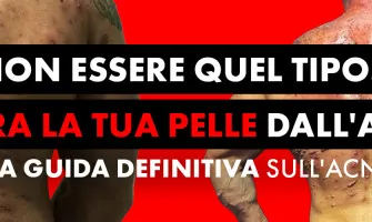 ACNE E STEROIDI