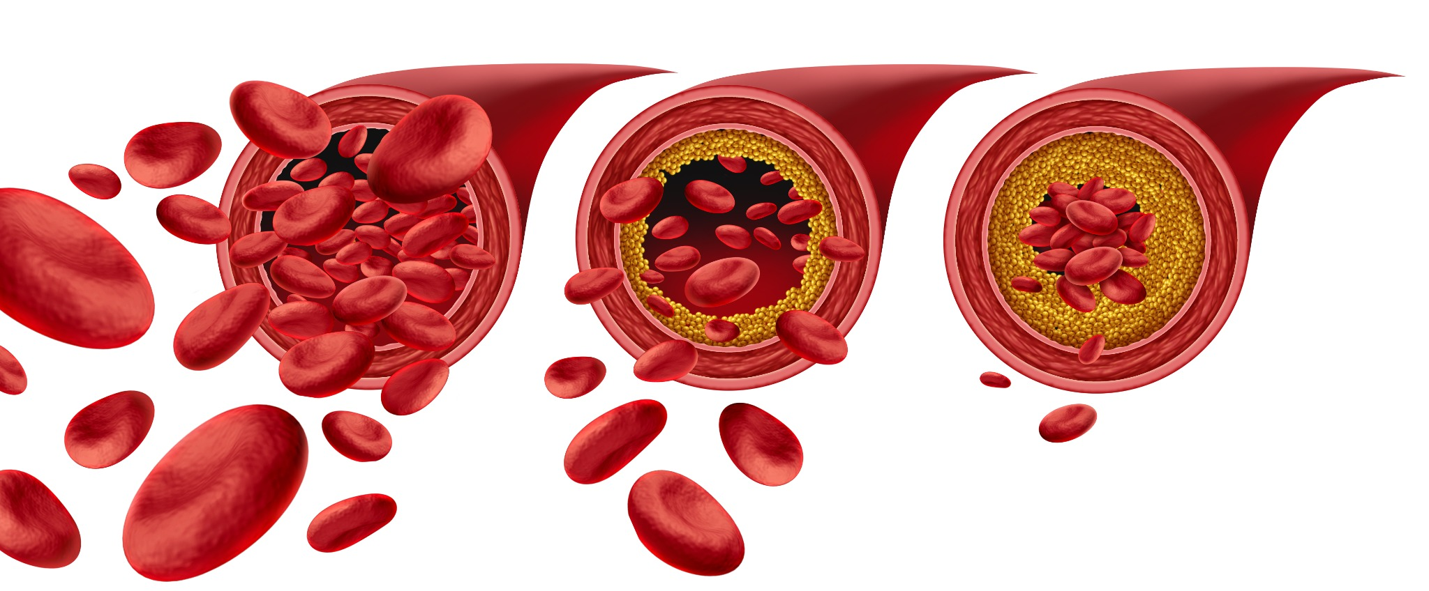 Atherosclerosis and arterial stiffness