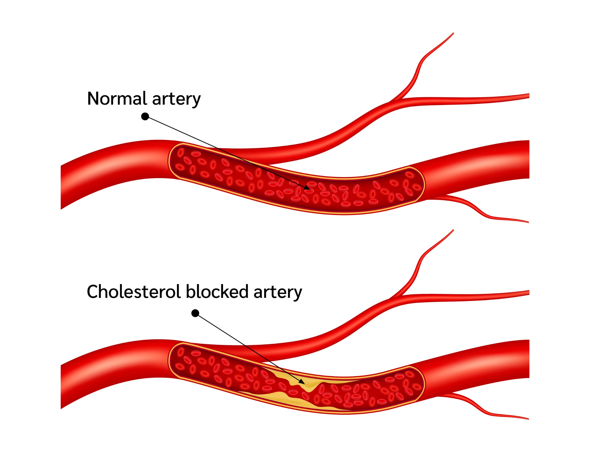 Cholesterol and atherosclerosis