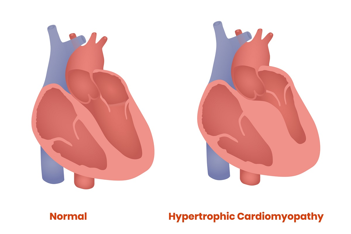 Heart and left ventricular hypertrophy